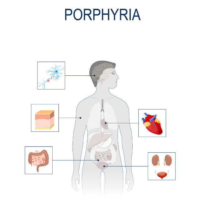 Porfyria